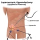 Image of laparascopic appendectomy. 3 or 4 small incisions made and appendix removed.