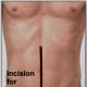 Shows the incision that may be made in case of a ruptured appendix.