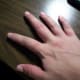 This is the port wine stain on the back of my right hand.