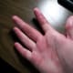 This is the port wine stain on the palm of my right hand.