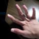 klippel-trenaunay-webber-syndrome-my-story