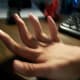 klippel-trenaunay-webber-syndrome-my-story