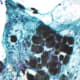 Pigmented malignant melanoma. One aspect of cell biology is cancer biology. Cell biologists are at the forefront of cancer research & treatment