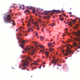 Squamous cell carcinoma of lung tissue. Whilst morphological analysis from a cell biologist suggested the cells were cancerous, evidence from the other strands of cell biology (biochemistry and genetics) are needed for a firm diagnosis.