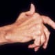 rheumatoid arthritis