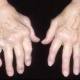 rheumatoid arthritis