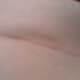 Main kidney removal scar approx 3.4 inches - above hip