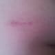 Left - drain scar, Middle - Laparoscopic scar, Right - kidney removal scar. See swelling above scar