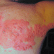 Herpes zoster image