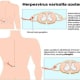 The Herpes zoster virus will travel along the nerves and cause a rash.