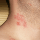 Shingles can appear as a rash on the neck