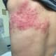 Photo of Rash in Shingles