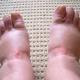 Pitting Edema