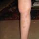 Leg Bruising That Is Associated With Kidney Disease