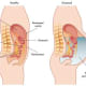 The difference between a healthy person and a person who has kidney disease. The one on the right suffers from Ascites.