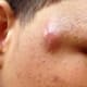 sebaceous-cyst-pictures-symptoms-removal-treatment-causes