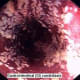 Candidiasis In The GI Tract