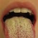 Oral Thrush