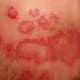 Candida Rash Yeast Infection On The Skin