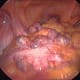 View of diverticula from a laparoscopic operation.