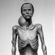 nf-neurofibromatosis-voices-what-some-of-us-want-you-to-know