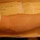 after ten laser treatments on left arm
