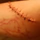 one day after excision on right arm