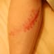 one month after and still healing