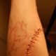 one day after excision on right arm