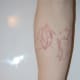 before excision and after ten laser treatments on right arm