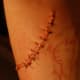 one day after excision on right arm