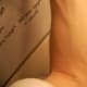 after ten laser treatments on left arm