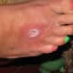 very similar to the infection I was unlucky enough to get on my most recent tattoo
