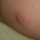 sebaceous-cyst-pictures-symptoms-removal-treatment-causes