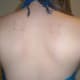 My scars three days later.