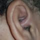 Perhaps the worst stage of my infection—the swelling had now spread to other parts of my ear, the skin is red and you can see some pus. It was also very painful!