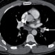 recovering-from-a-pulmonary-embolism