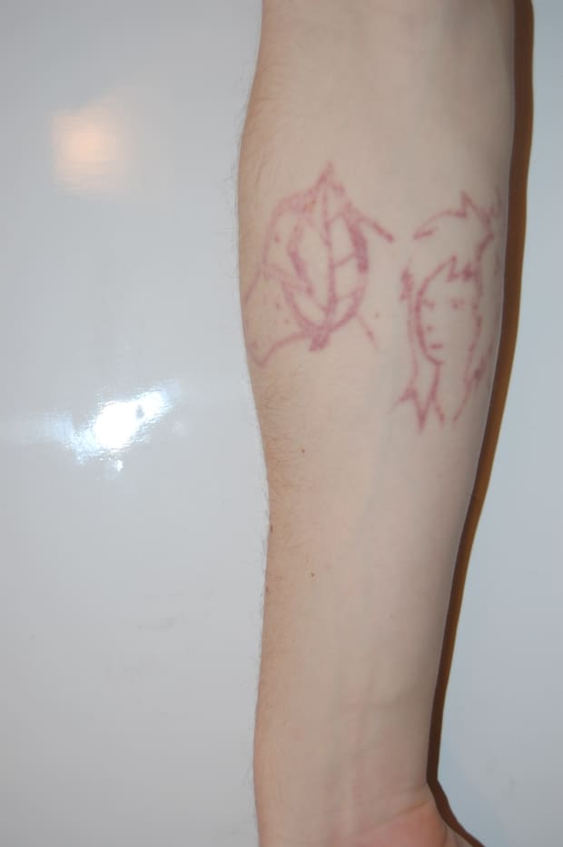 My Experience With Surgical Excision and Laser Tattoo Removal Procedures -  TatRing