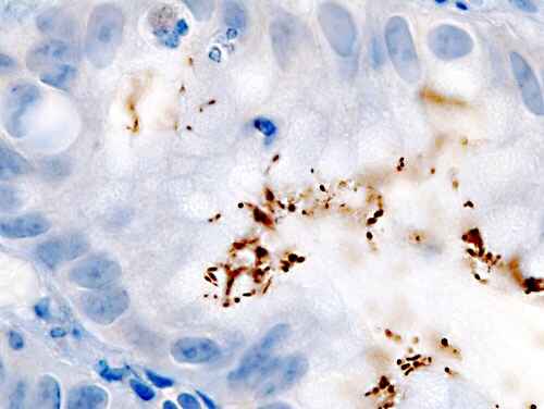 Helicobacter pylori (stained brown) in a sample taken from a person's stomach lining (stained blue)