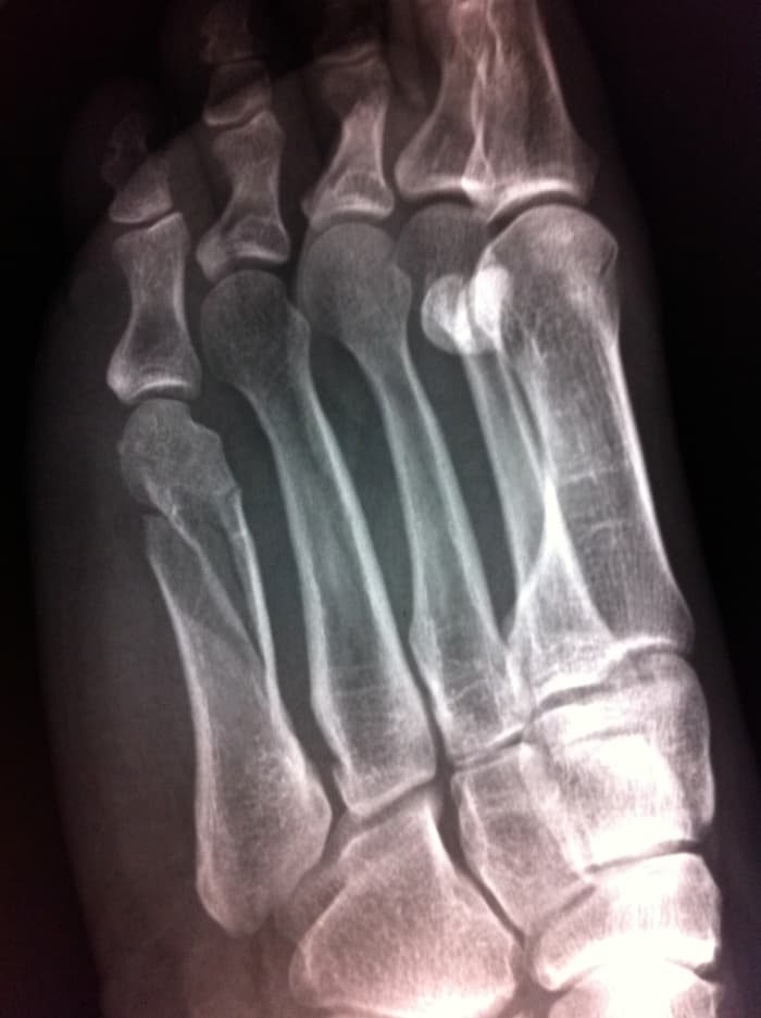 Twisted and broke my 5th metatarsal in my foot due to decreased bone density. This happened over a year after I stopped taking it.