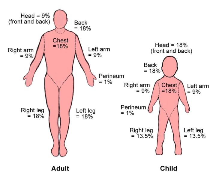 How To Recognize And Treat 6 Degrees Of Burns Youmemindbody 9081