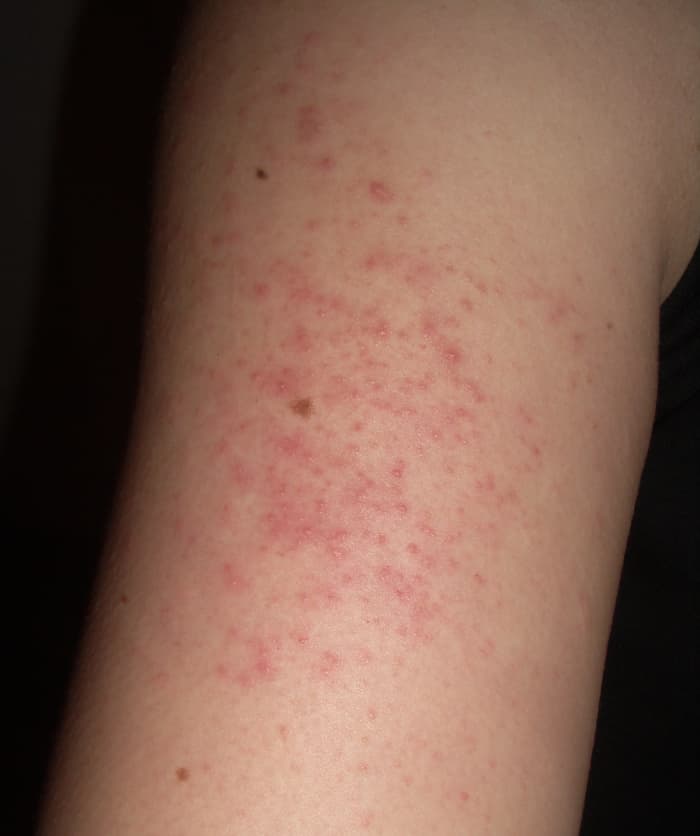 Keratosis pilaris, or follicular keratosis or lichen pilaris on the upper arm. This condition is also called "chicken skin."