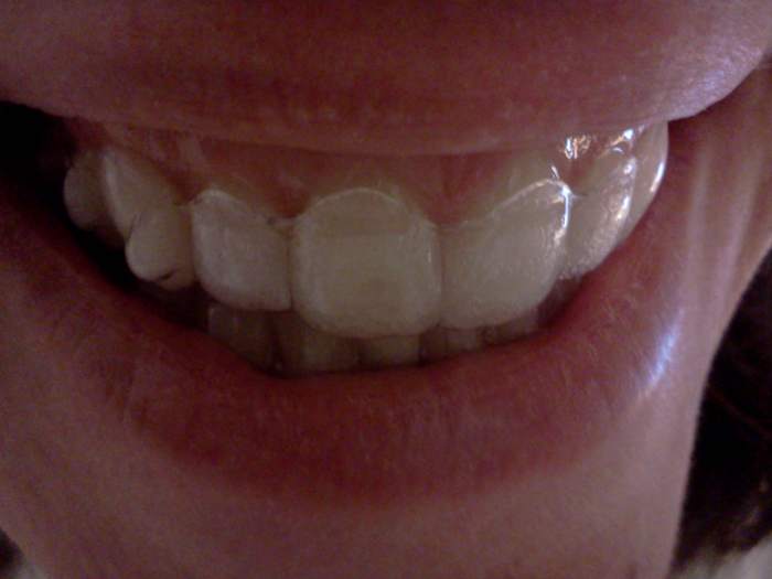 How I Prevent Cavities While Using Invisalign Patient's Lounge