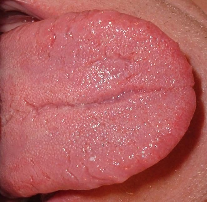 A healthy tongue that has fissures, or cracks; people with a fissured tongue have an increased risk of developing a geographic tongue