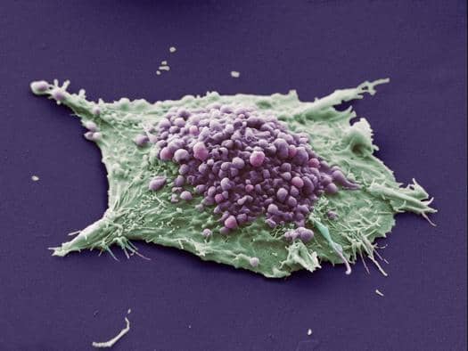 A fake-colour image of a blebbing cancer cell. The jagged edges show the cell is cancerous. Blebbing can be seen in purple. Each bleb will fall away (hence 'apoptosis') and be consumed by white blood cells