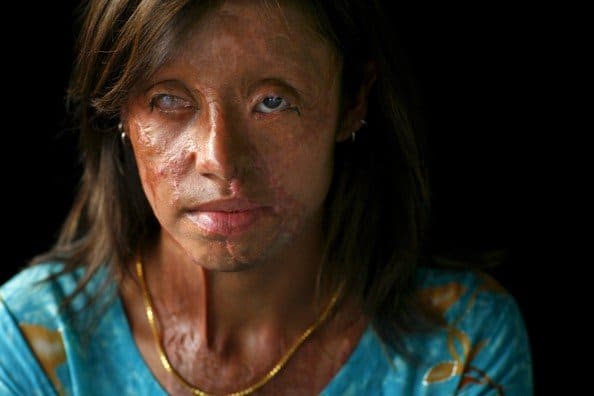 This Pakistani woman was blinded and scarred from an acid attack when her family could not pay her dowry. Many other women suffer worse disfigurment.