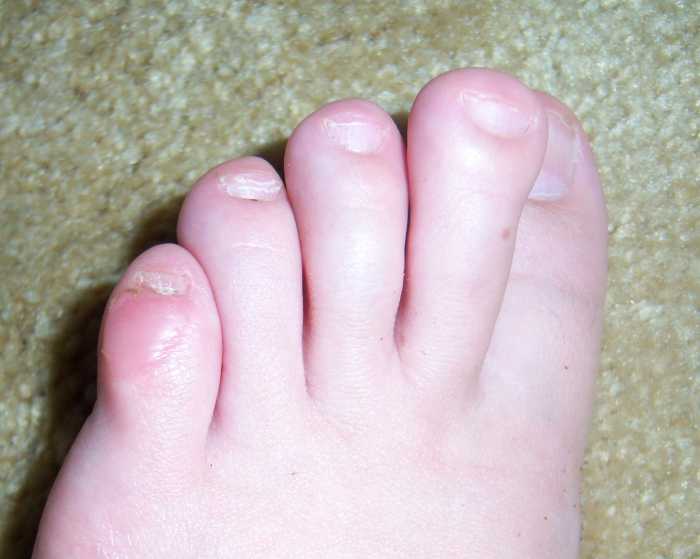 Personal on How to Care for a Foot Blister Patient's