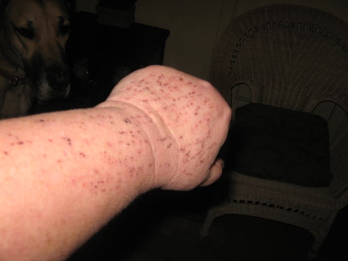 One of the worst symptoms of nerve damage is an intense itch that can't be relieved with scratching... €”but you can't help but scratch, anyway. I do it in my sleep.