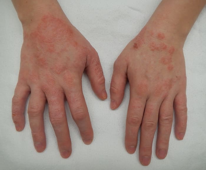 Eczema presents in a number of ways, but it is often triggered by environmental irritants, autoimmune reactions, and/or genetics.