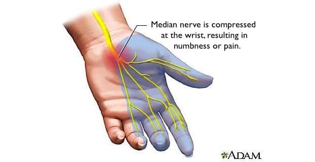 When the Carpal Tunnel is inflamed from irritation, it can put pressure on the Median Nerve that goes through the tunnel.